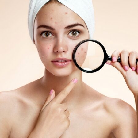 How to Hide Acne Without Makeup